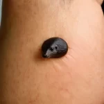 Nốt ruồi ở bìu nam giới