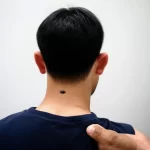 Nốt ruồi sau gáy nam giới