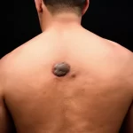 Nốt ruồi sau lưng đàn ông